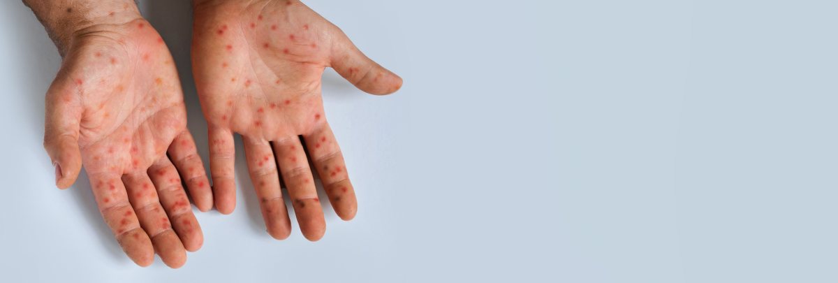 חצבת | אילוסטרציה shutterstock